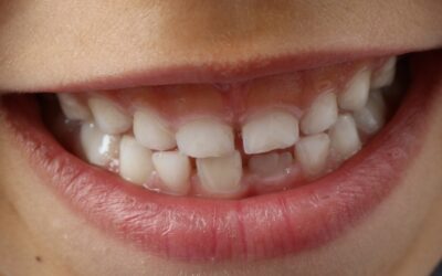 AIUTO! MIO FIGLIO HA UN DENTE IN DOPPIA FILA !!