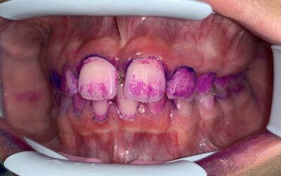Tuo figlio ha delle macchie sui denti?