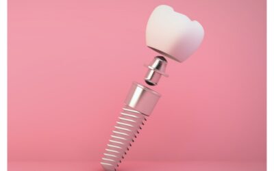 Com’è fatto un impianto dentale?