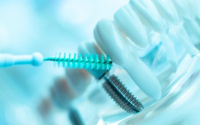 L’impianto: un dente finto che va curato come uno vero… forse anche MEGLIO!